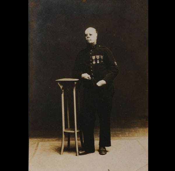 Portrait d'une Gueule cassée, un soldat français médaillé, sans cheveux, visage déformé et mains atrophiées. © Historial de la Grande Guerre-Péronne (Somme).